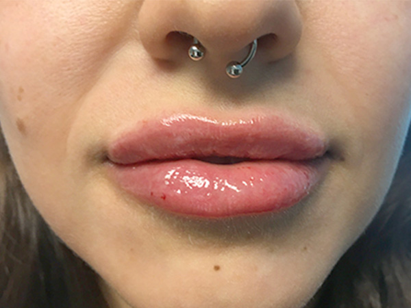 Injectables And Fillers 34