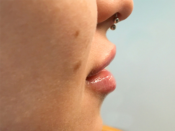 Injectables And Fillers 03