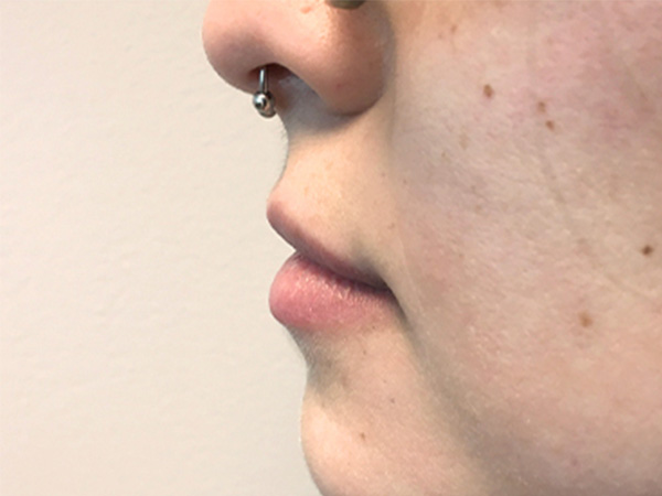 Injectables And Fillers 05