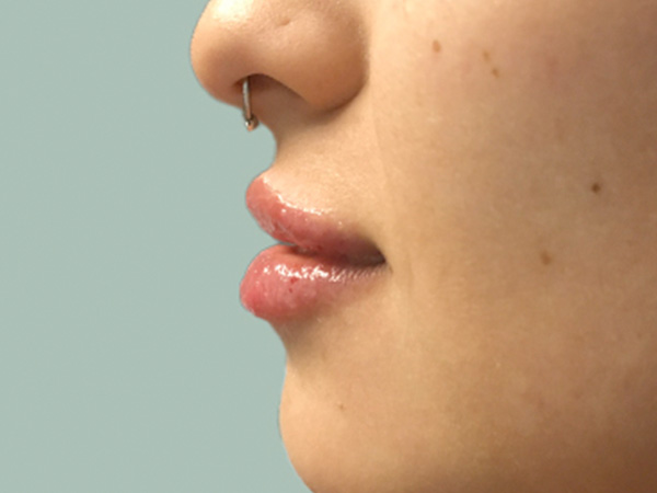 Injectables And Fillers 05