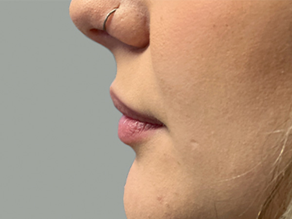 Injectables And Fillers 05