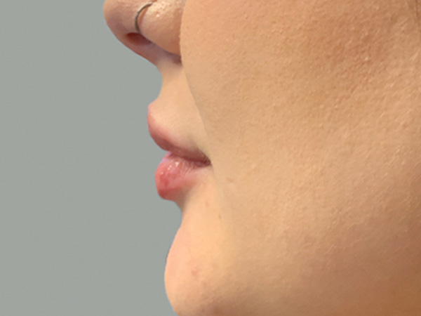 Injectables And Fillers 05