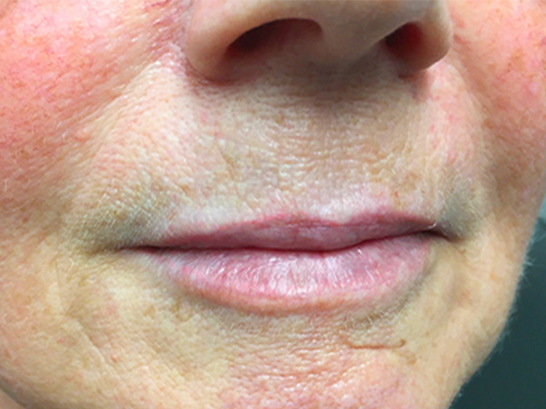 Injectables And Fillers 03