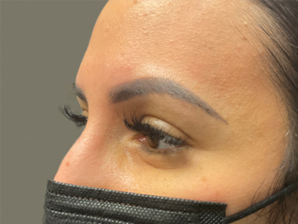 Injectables And Fillers 38