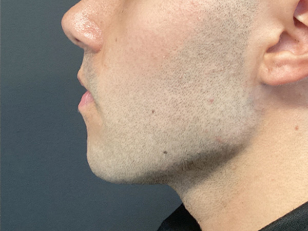 Injectables And Fillers 39