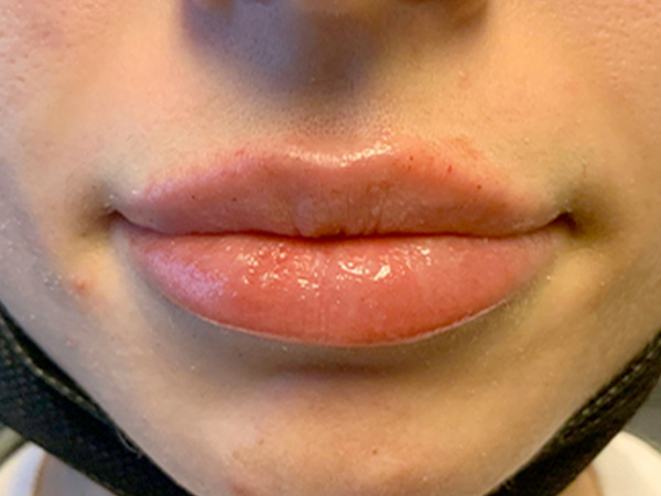 Injectables And Fillers 42