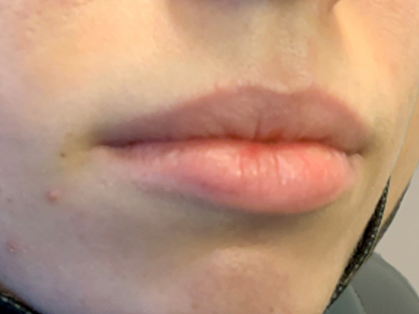 Injectables And Fillers 03