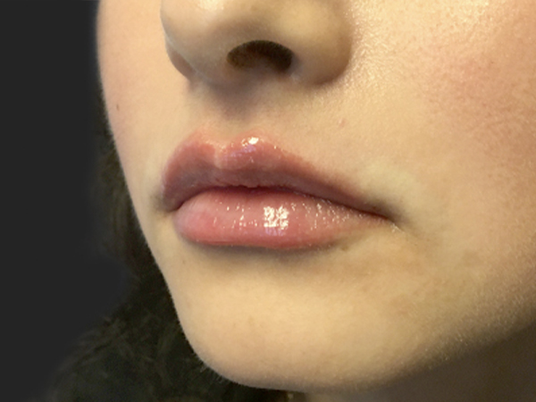 Injectables And Fillers 03