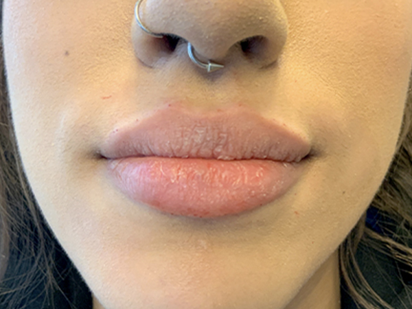 Injectables And Fillers 44