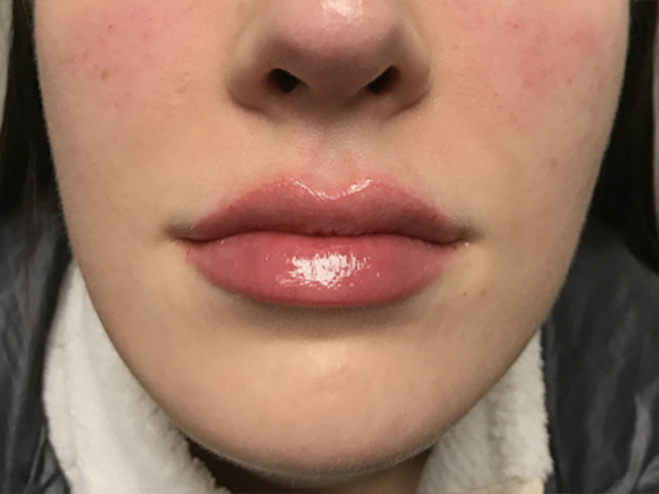 Injectables And Fillers 45