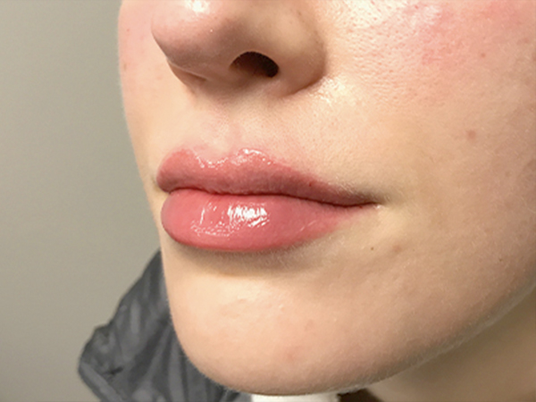 Injectables And Fillers 03