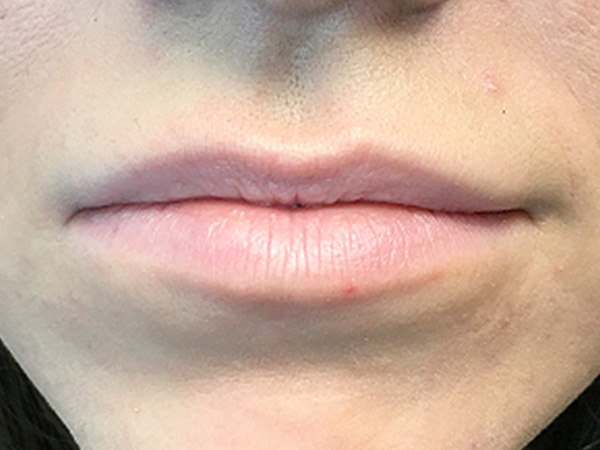 Injectables And Fillers 01