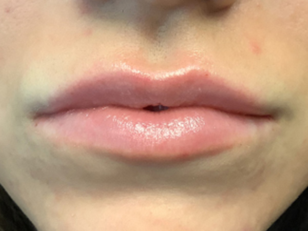 Injectables And Fillers 46