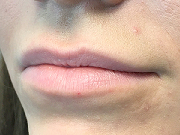 Injectables And Fillers 03