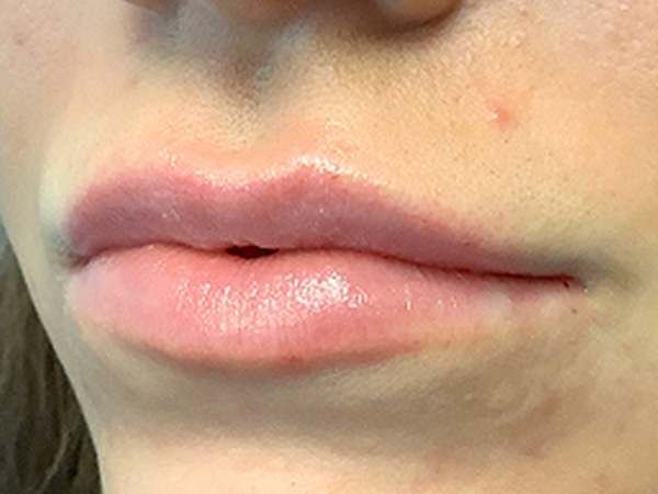 Injectables And Fillers 03