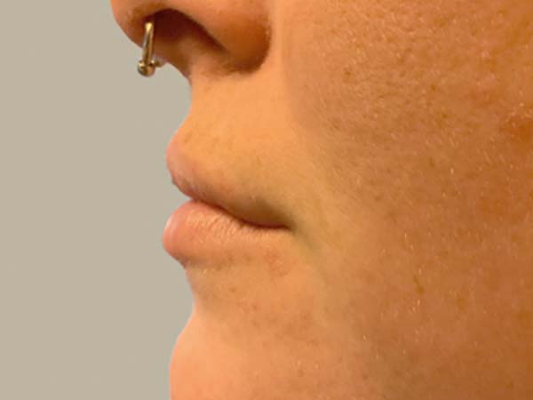 Injectables And Fillers 03