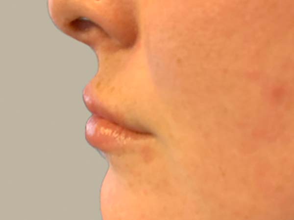 Injectables And Fillers 03