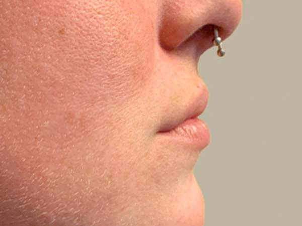 Injectables And Fillers 05