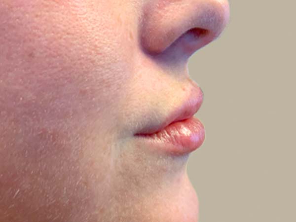 Injectables And Fillers 05