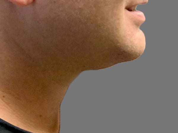 Injectables And Fillers 48