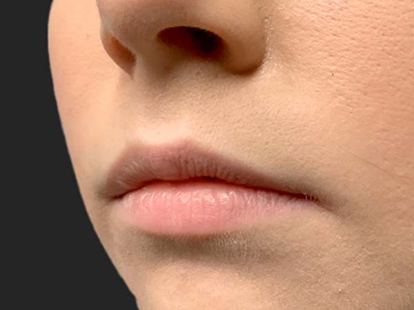 Injectables And Fillers 03