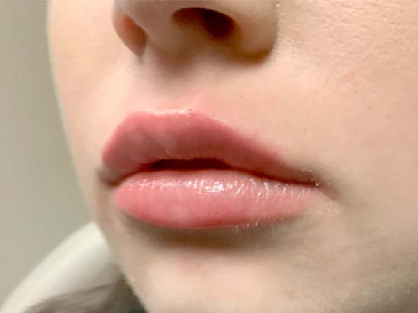 Injectables And Fillers 03