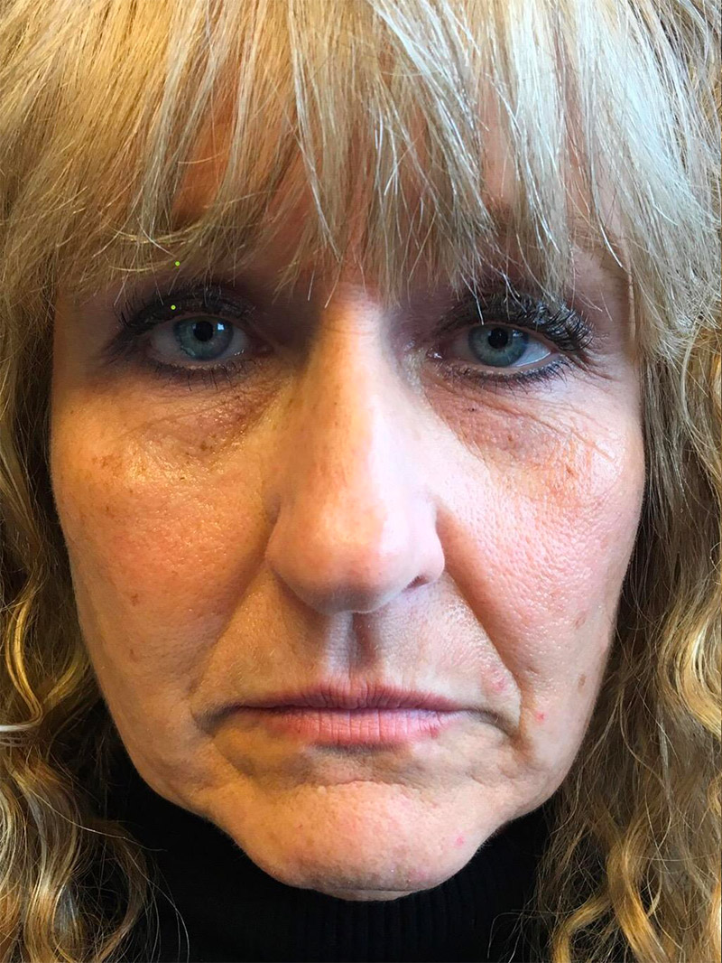 Injectables And Fillers 01