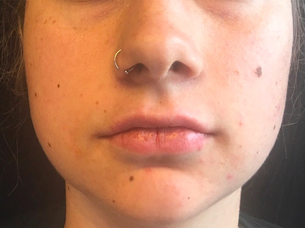 Injectables And Fillers 53