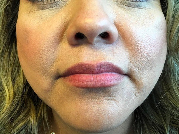 Injectables And Fillers 01