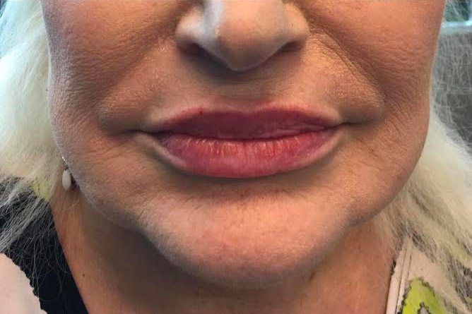 Injectables And Fillers 55