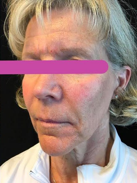 Injectables And Fillers 56