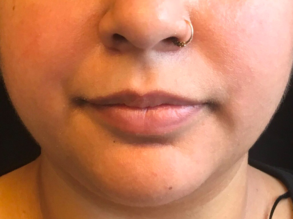 Injectables And Fillers 01