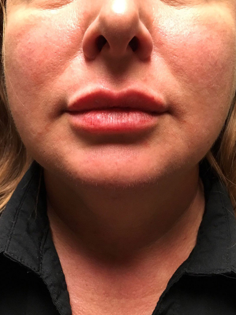 Injectables And Fillers 58