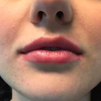 Injectables And Fillers 59