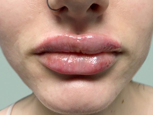 Injectables And Fillers 60