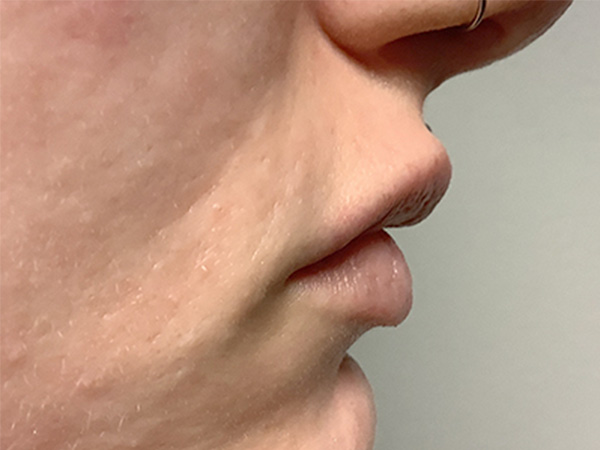 Injectables And Fillers 03