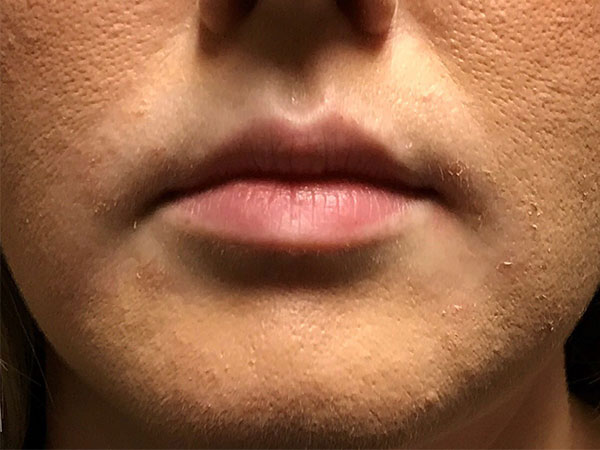 Injectables And Fillers 01