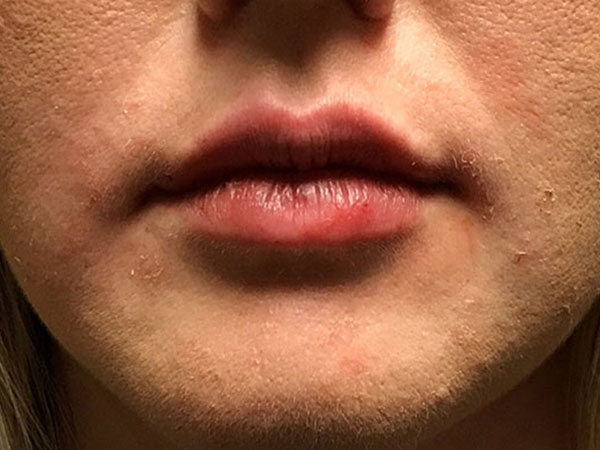 Injectables And Fillers 61