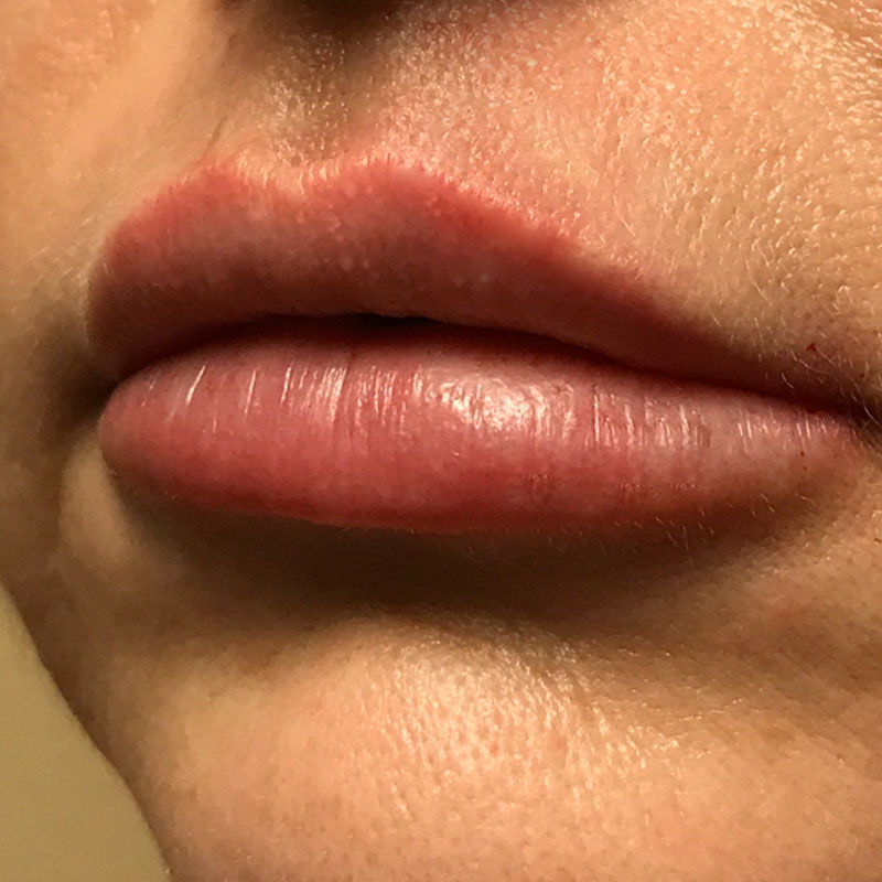 Injectables And Fillers 62