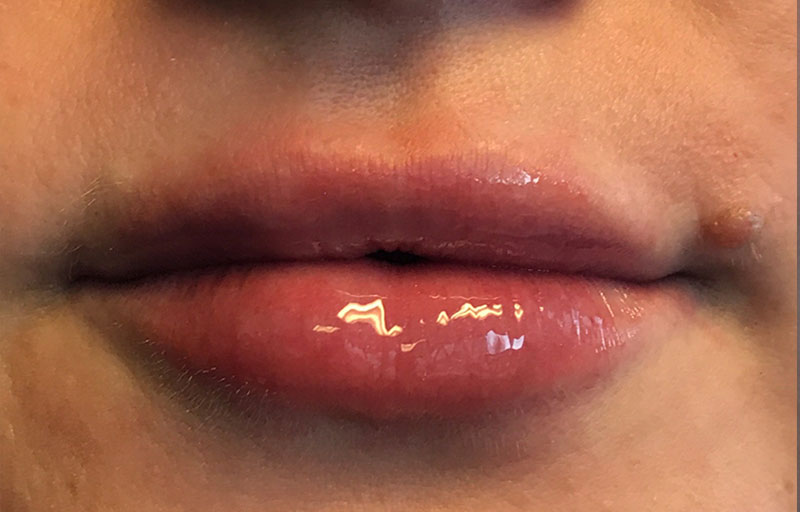 Injectables And Fillers 63