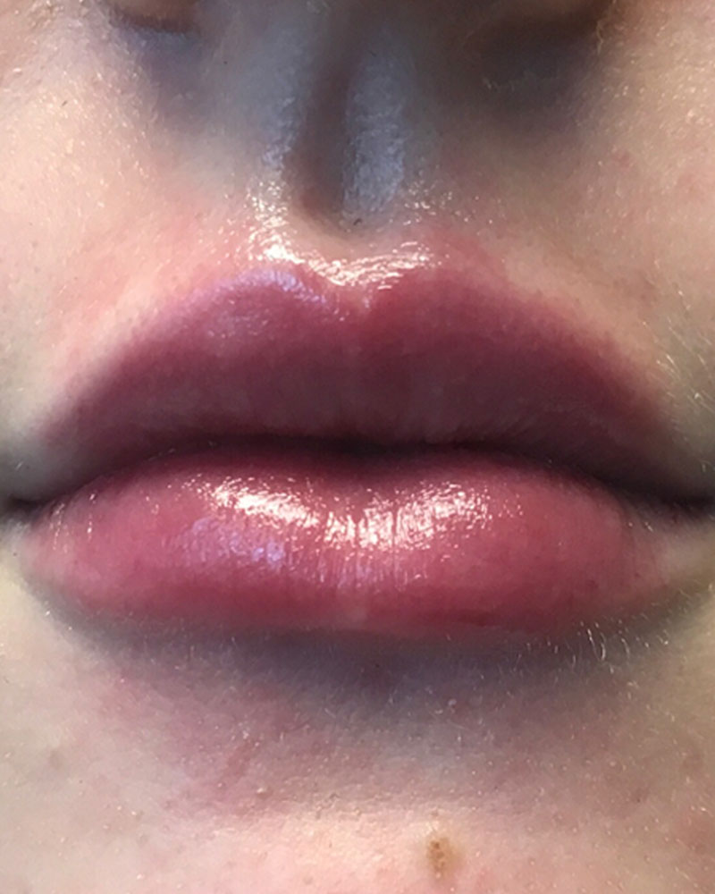 Injectables And Fillers 64