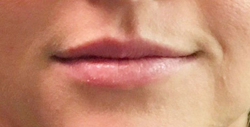 Injectables And Fillers 01