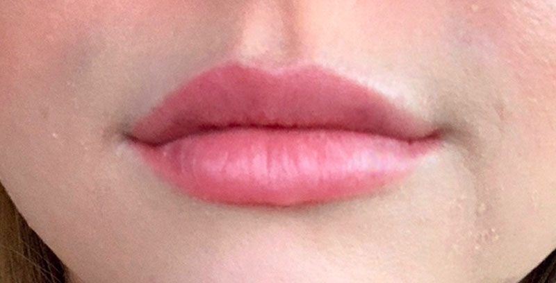 Injectables And Fillers 65