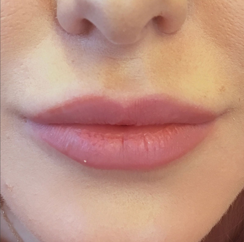 Injectables And Fillers 01