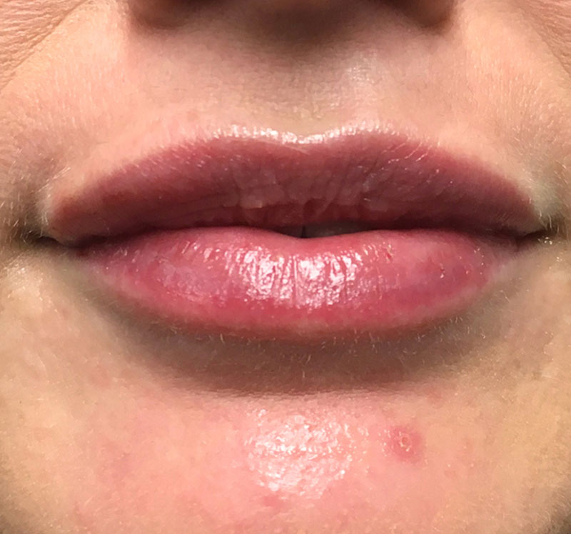 Injectables And Fillers 67