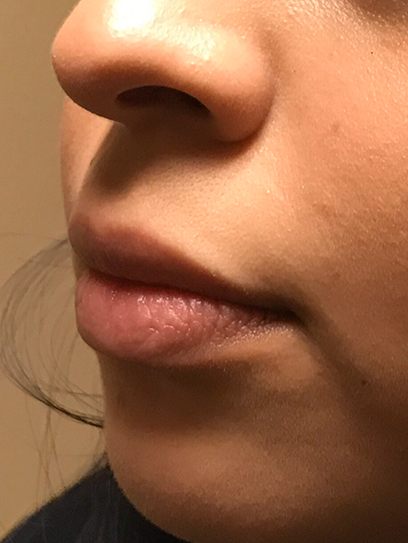 Injectables And Fillers 03