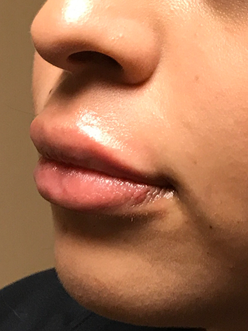 Injectables And Fillers 03