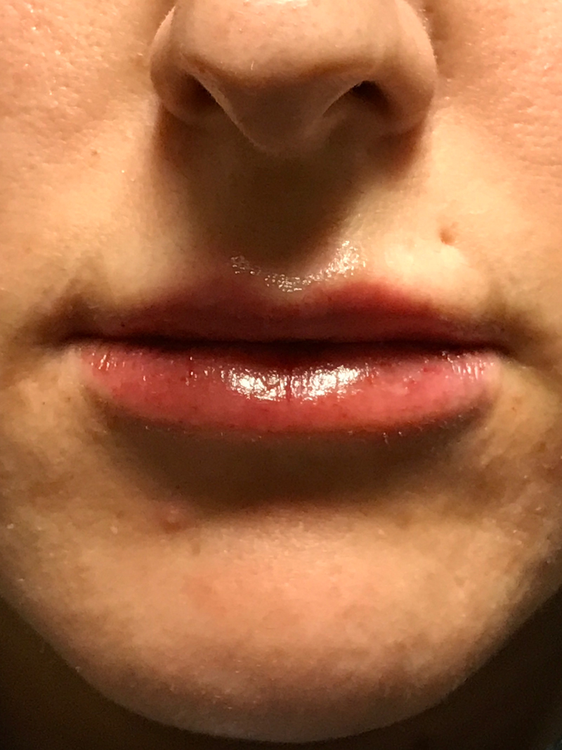 Injectables And Fillers 69