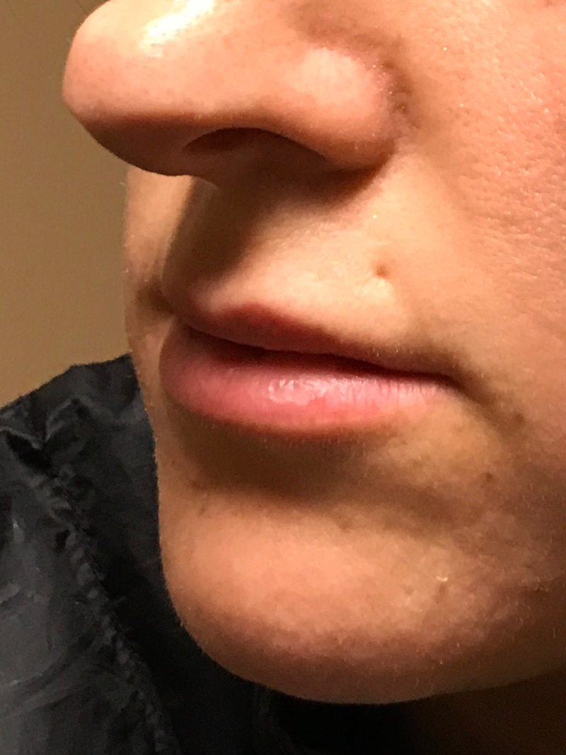 Injectables And Fillers 03