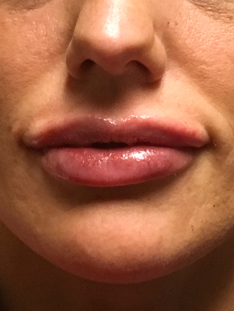 Injectables And Fillers 70